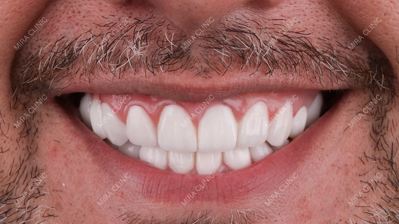 Smile Design